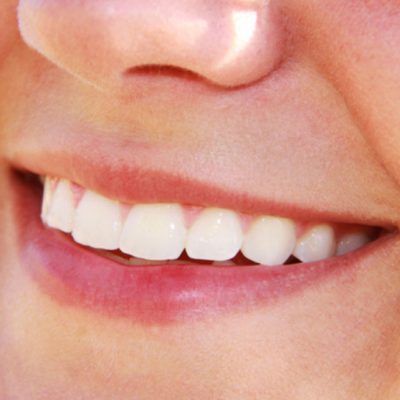 avondale-dental-clinic-wicklow-tooth-whitening2