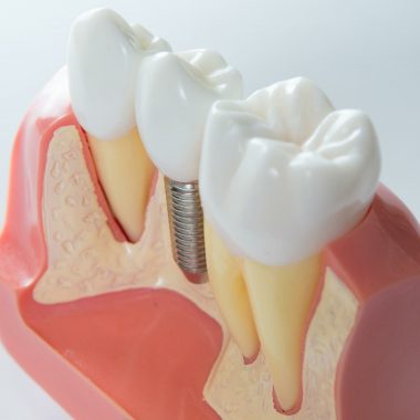 Dental Implants Bray Wicklow